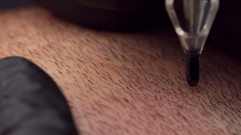 Micropigmentation on FUE scars in the donor area.