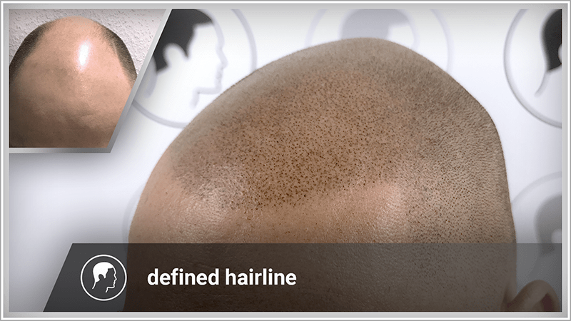 Man with advanced hair loss chooses scalp micropigmentation instead of a toupee.