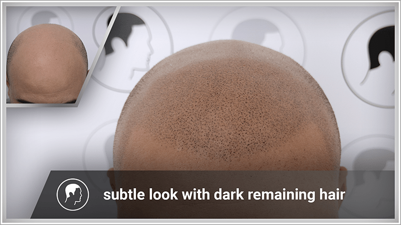 Scalp micropigmentation looks much more natural than a toupee.