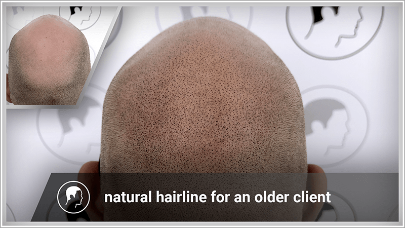 Like a toupee, scalp micropigmentation conceals total hair loss.