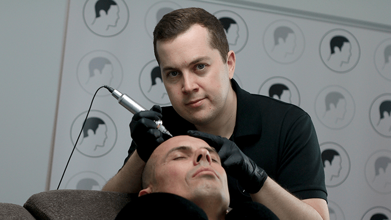 Scalp micropigmentation in action, on a client with alopecia androgenetica