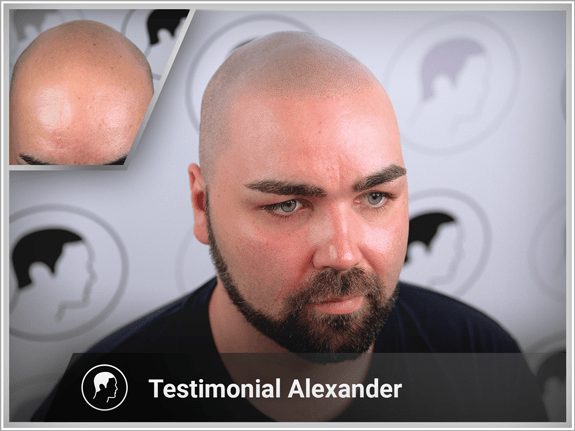 Alexander's interview