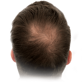 Hair thickening
