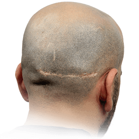 Scar micropigmentation